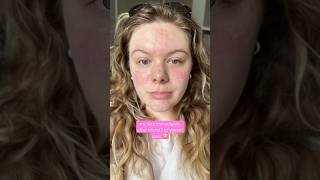 vbeam laser for rosacea redness lasertherapy skincare [upl. by Alekat811]