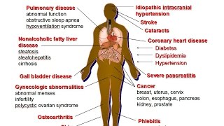 Nutrition Related DiseasesDeath Rates amp Obesity [upl. by Sperry]