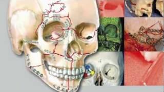 Craniomaxillofacial Buttresses Anatomy and Operative Repair [upl. by Gibert]