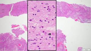 Glioblastoma histopathologic diagnosis  Adventures in Neuropathology [upl. by Etnuaed508]