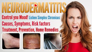 Neurodermatitis Causes Symptoms Treatment Prevention and Home remedies  Lichen simplex chronicus [upl. by Arinaid]