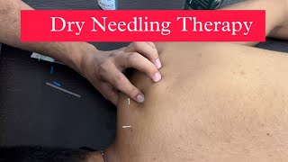 Dry Needling Treatment for Neck pain [upl. by Greenburg145]