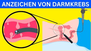 7 Warnzeichen von Darmkrebs Was Sie wissen müssen [upl. by Elleunamme359]