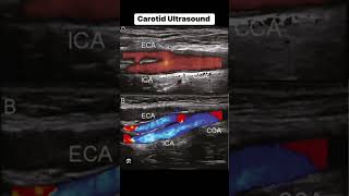 Carotid Ultrasound [upl. by Ahsil]