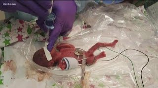 World’s smallest surviving baby born in San Diego [upl. by Legnaesoj]