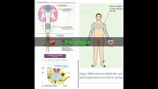 Paraplegia [upl. by Donnelly]