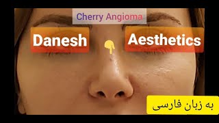 چطور می‌توان خال قرمز رنگ یا توده عروقی خوش خیم پوستی را ظرف کمتر از یک دقیقه برداشت؟ [upl. by Kcirdneh]