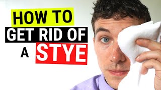 How to Get Rid of a Stye FAST  Chalazion VS Stye Treatment [upl. by Itnaihc]