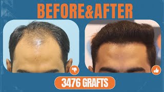 Transformed Witness the Natural Results of a 3476 Graft Hair Transplant at Alloroots [upl. by Ebberta]