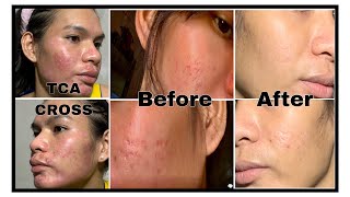 TCA CROSS TREATMENT BEFORE AND AFTER  TCA CHEMICAL PEEL AT HOME  How to treat Acne Acars youtube [upl. by Miriam]