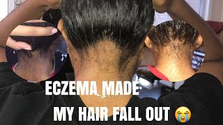 BAD Scalp Eczema amp Nape Breakage  Pictures amp My Natural Routine [upl. by Yart]