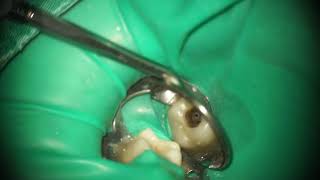 Root canal treatment Patency and Gilde Path [upl. by Els]