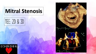 Mitral Stenosis [upl. by Adachi220]