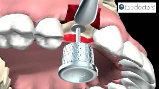 Implantes dentales qué son tratamiento y mantenimiento [upl. by Ettenowtna63]