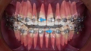 Clinical tip Midline Correction with Intermaxillary Elastics｜【Chris Chang Ortho】CC451 [upl. by Ahtiek]