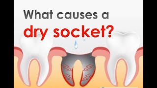 Dry Socket Alveolar Osteitis I Prevention and Treatment I Oral Surgery I Dental Guide I [upl. by Ardath552]