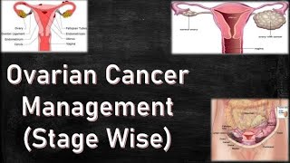 Ovarian Cancer  Stagewise Management [upl. by Irolam434]