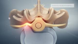 «Rückenschmerzen – Infiltration an der Lendenwirbelsäule»  Schulthess Klinik [upl. by Assanav]