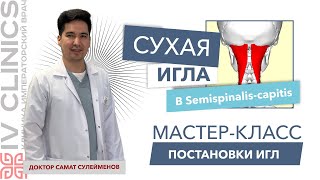 Сухая игла в SEMISPINALIS CAPITIS Полуостистая мышца  Мастеркласс постановки сухой иглы [upl. by Anaej]