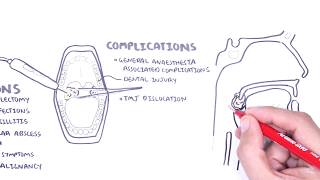 Acute Tonsillitis  causes viral bacterial pathophysiology treatment tonsillectomy [upl. by Abram]