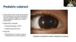 Lecture Surgical Approach to Pediatric Cataracts [upl. by Morganne]