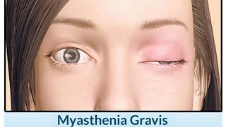 Myasthenia Gravis causes of myasthenia gravis clinical features of myasthenia gravis [upl. by Stahl]