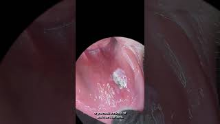 A new way to treat canker sores aphthous ulcers dentalhygiene dentalpain cankersores [upl. by Shanly]