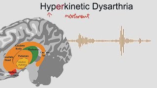 Hyperkinetic Dysarthria  samples and explanation [upl. by Ialohcin407]