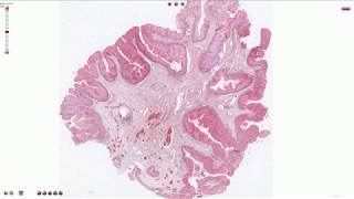 Condyloma  Histopathology [upl. by Zubkoff]