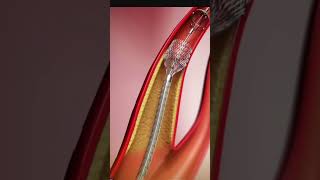 ANGIOPLASTY PROCEDURE ANIMATED [upl. by Byrn]