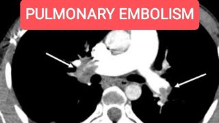 Pulmonary Embolism with multiple hepatic metastasis  CT Chest with Whole Abdomen [upl. by Sucramal]