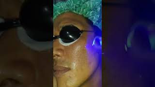 facial peelinglaser [upl. by Shaun481]