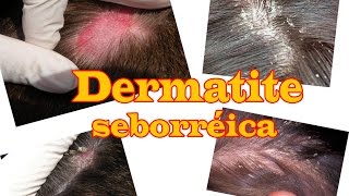 Caspa e dermatite seborreica como controlei [upl. by Par26]