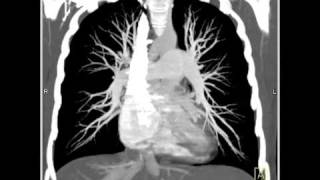 Lung Anatomy Pulmonary Embolism MIP [upl. by Jessabell627]