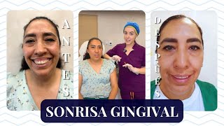 SONRISA GINGIVAL BÓTOX para dejar de mostrar las ENCÍAS al SONREÍR I MARISOL GÓNGORA [upl. by Ellenehs8]