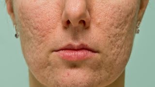 How to Get Rid of Big Acne Bumps  Smooth Skin Routine [upl. by Nosnorb]