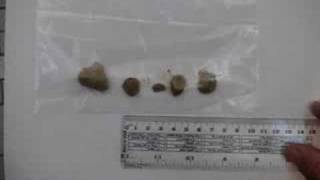 Liver and Gallbladder Flush  1 inch stone [upl. by Damiano]