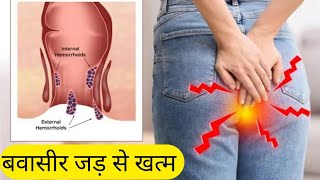 Hemorrhoids अंग्रेजी Medicine से बवासीर अब जड़ से समाप्त Piles Treatment By Allopathic Medicine [upl. by Harl]