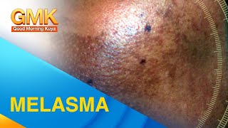 MELASMA Cause and Treatment Explained by Dermatologist [upl. by Bruning]