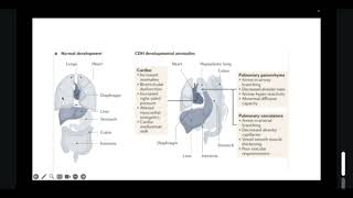 Cirugía Pediátrica  Hernia Diafragmática Congénita 11 [upl. by Tireb]