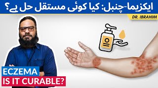 EczemaChambal Ka Ilaj  How To Treat Eczema  Jild Ki Kharish Ka Ilaj UrduHindi Dr Ibrahim [upl. by Resay]