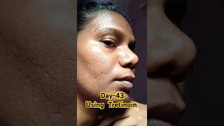 Day43 Using Tretinoin viralvideo tretinoin skincare shorts youtubeshorts [upl. by Bunce320]