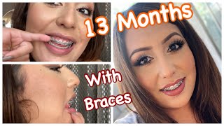 13 Months with BRACES  OverjetOverbite Correction Without Extractions  Damon Braces [upl. by Orabla]