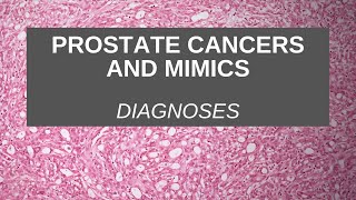 Prostate Cancers and Mimics  Diagnosis [upl. by Tacy205]