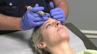 Microneedling procedure [upl. by Havens]