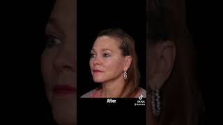 Facelift Surgery Before amp After  Facial Plastic Surgeon Dr Robert Glasgold [upl. by Esdnyl]