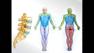 Nucleoplastía  La solución definitiva a las hernias discales [upl. by Arihs688]