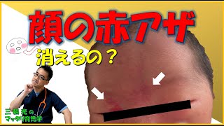 【1か月健診（身体のこと）】顔の赤アザ（サーモンパッチ）って消えるの？ [upl. by Shoshana]