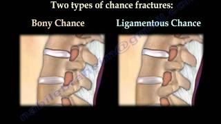 Chance Fractures of the Spine  Everything You Need To Know  Dr Nabil Ebraheim [upl. by Reviere]