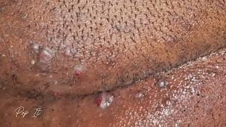 Satisfying Ingrown Hair Removal Back of head  Pt 3 [upl. by Ehgit]